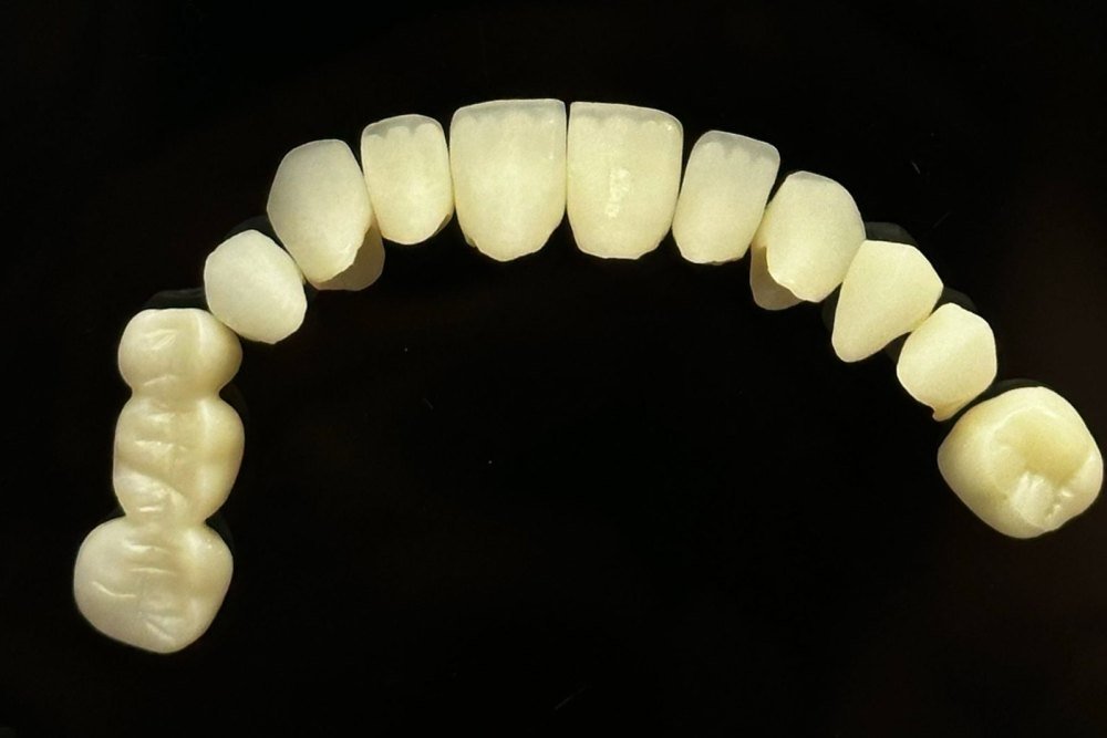 A full arch of tooth-colored ceramic crowns and bridge units arranged on a black background