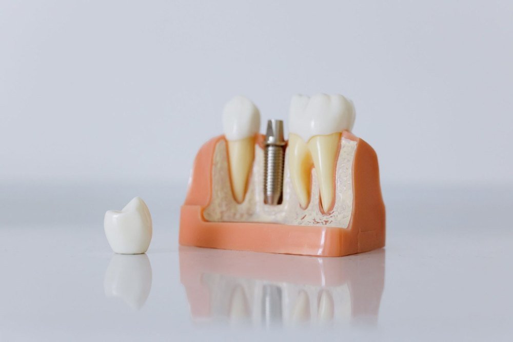 A cutaway dental model showing an implant post between two natural teeth, with a white crown set beside it