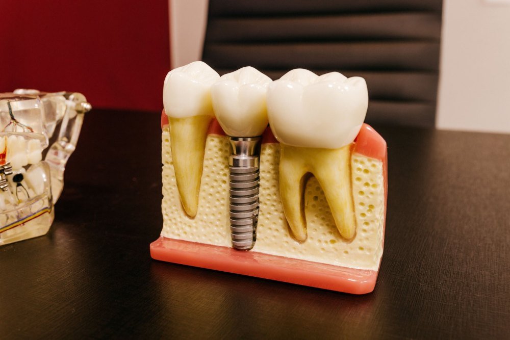A cutaway dental model on a dark desk shows a titanium implant post topped with a crown between two natural teeth